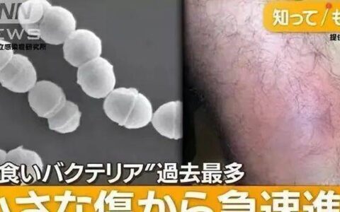 正在日本蔓延的“食人菌”到底是什么？-日本食人部队