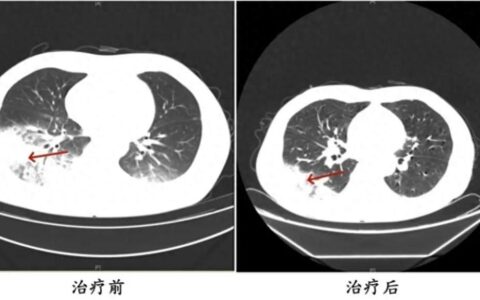发热、寒战、咳嗽……接连两人确诊，严重可致死！几乎家家都在用，医生紧急提醒→-寒咳发烧吃什么药止咳效果好